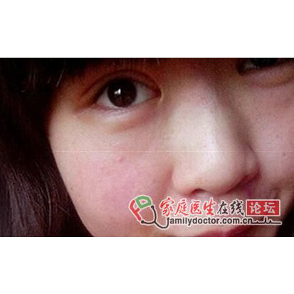 做了E光美容,脸上红血丝不见了