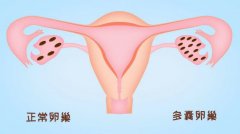 卵巢不好好排卵，到底是出了啥问题?快来